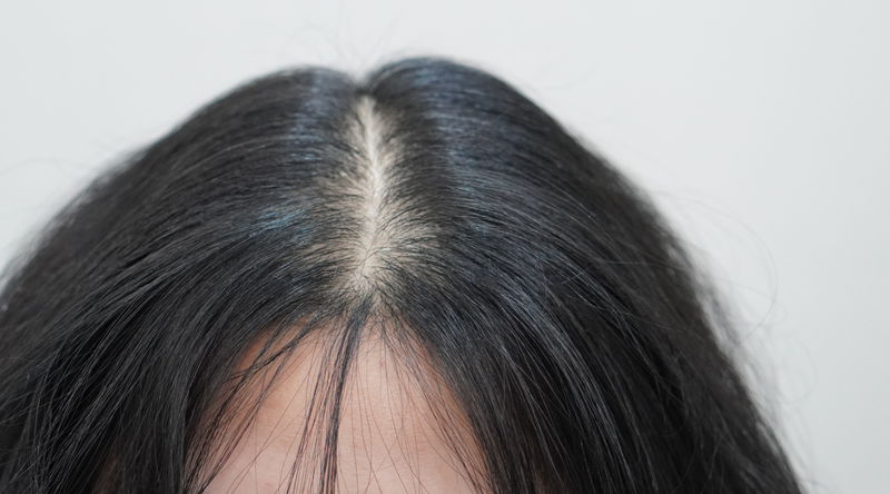 뉴헤어부산의원 탈모주사치료 12회