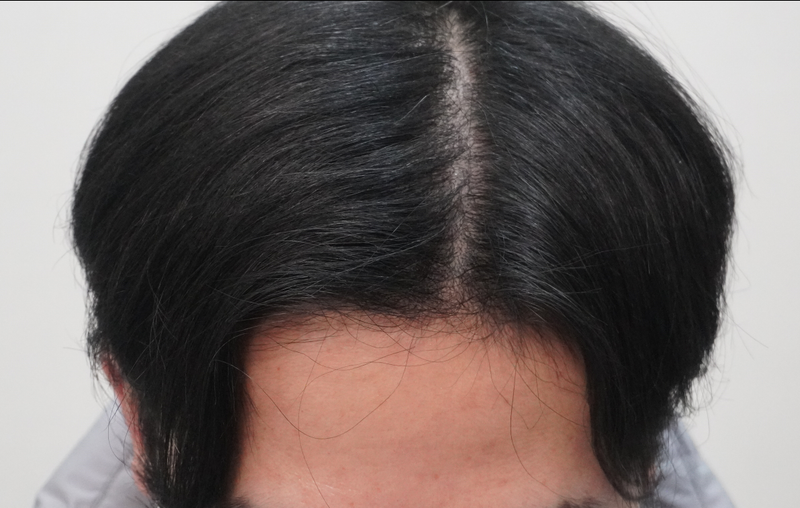 부산 뉴헤어에서 주사 8번째 치료 하고 왔습니다