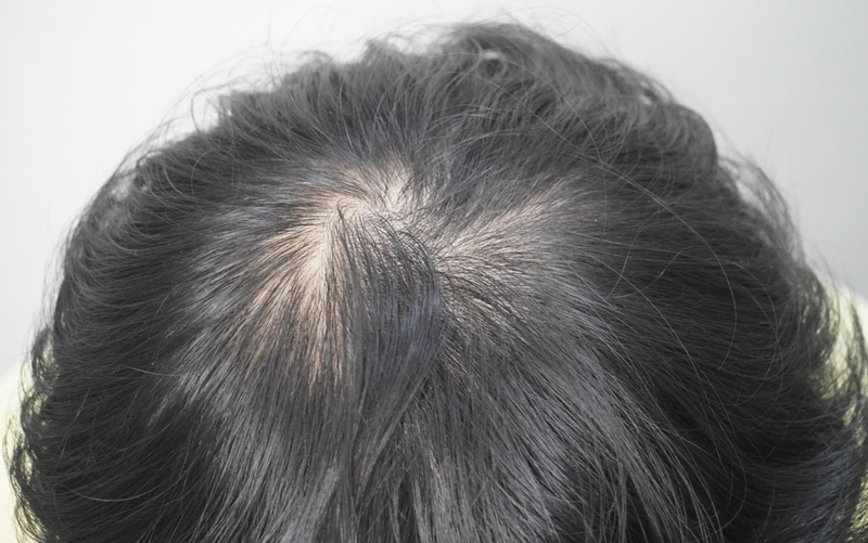 [부산점]뉴헤어모발성형외과에서 탈모 치료 4회차 후기