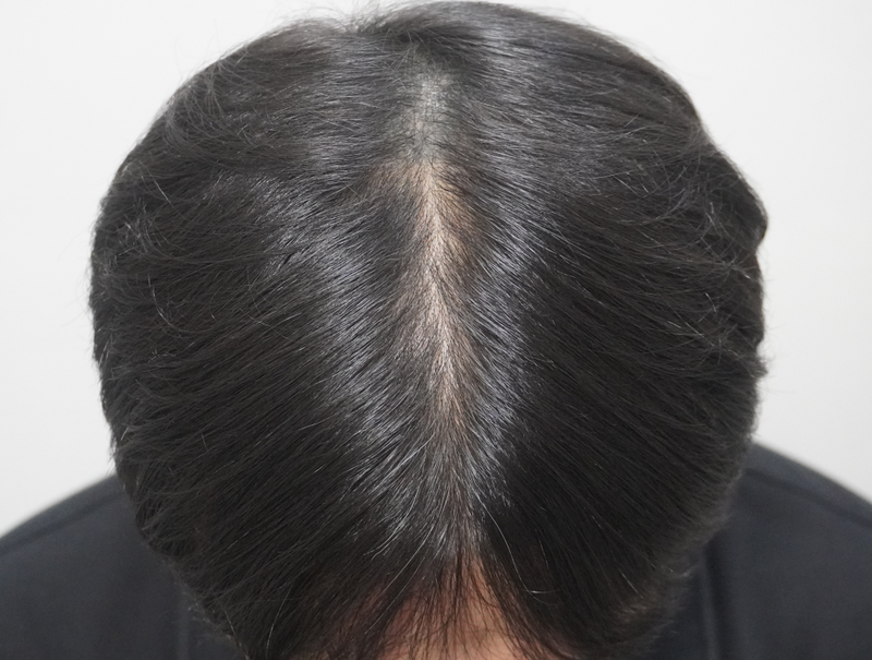 부산 뉴헤어의원 에서 탈모 치료 시작