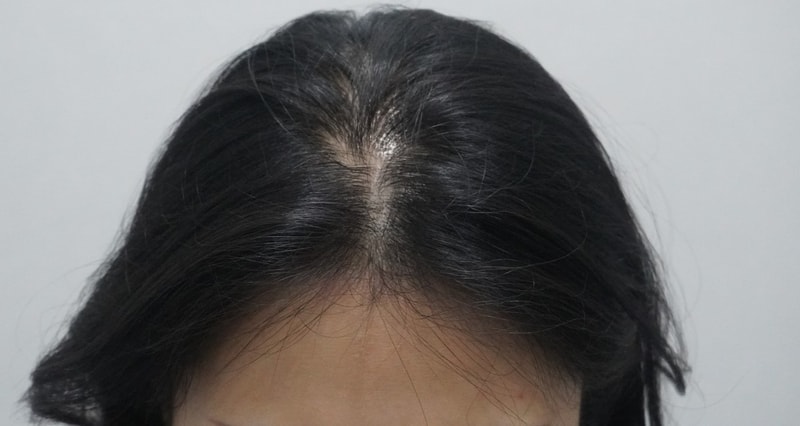 뉴헤어부산의원 주사치료 1회차 후기