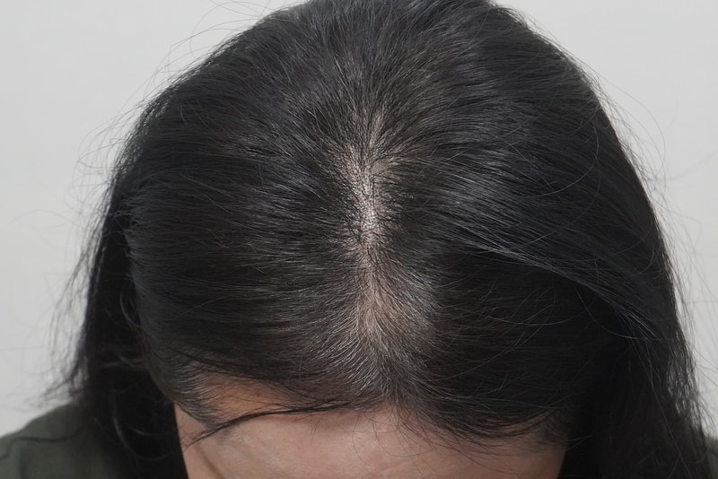 뉴헤어부산의원에서 탈모 치료 4회 차 후기요 !