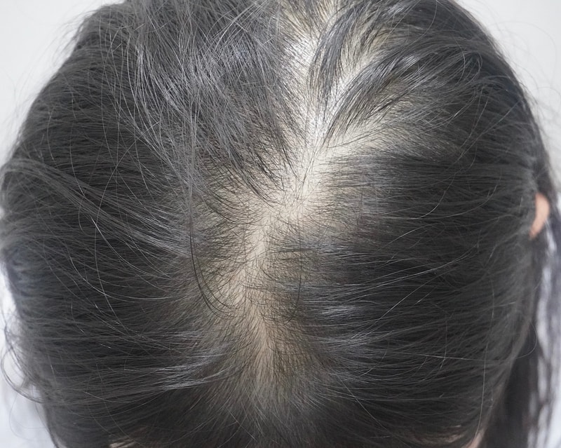 뉴헤어 부산의원에서 탈모치료 두달 차입니다