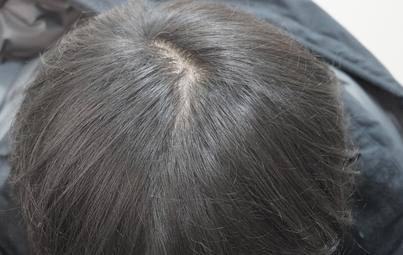 8회차 치료후기( 뉴헤어부산점 )