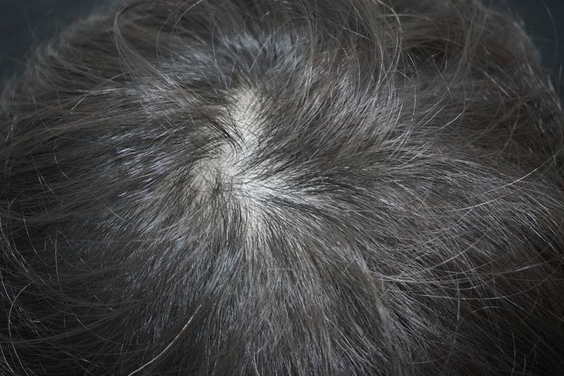 뉴헤어부산의원 모낭주사 12회차 후기입니다