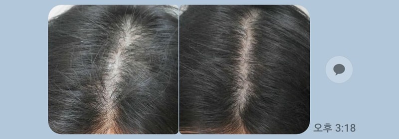 부산 해운대점 뉴헤어의원 4회차 치료후기