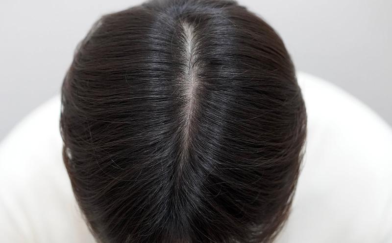 뉴헤어부산의원 주사 치료 12회차 완료 후기