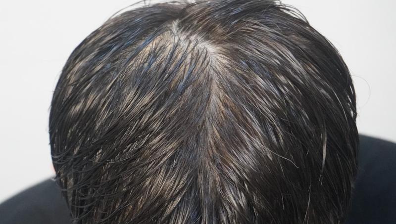 [부산점] 뉴헤어부산의원 1일차 탈모치료 후기