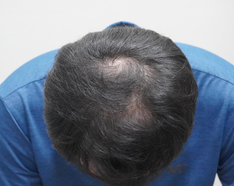 ニューヘア釜山薄毛治療8回目の後