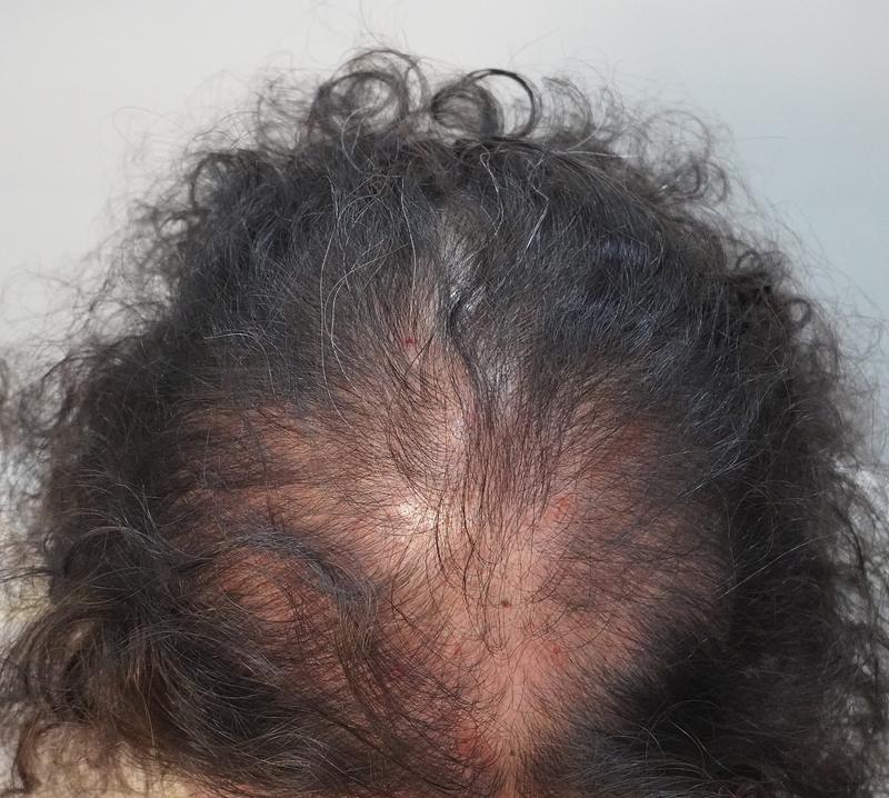 뉴헤어부산의원에서 주사치료 꾸준히 받고 있습니다 (12회)