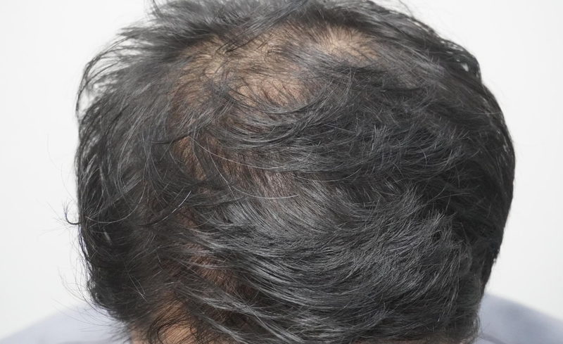 뉴헤어부산의원에서 4회차 치료 후기