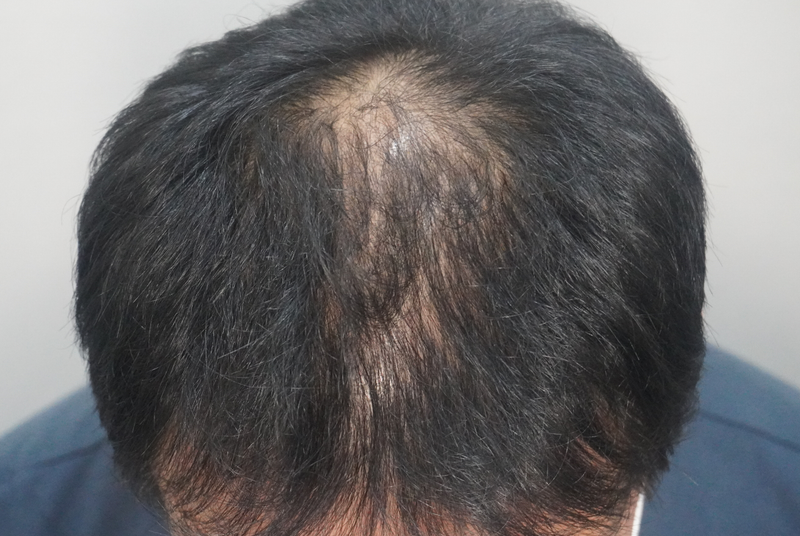 뉴헤어부산의원에서 탈모치료 4회 차 후기