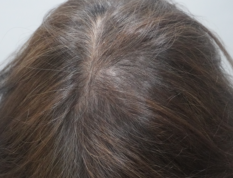 [뉴헤어부산의원] 탈모 치료 상담, 시술