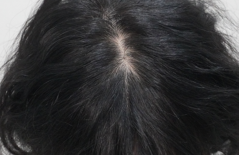 부산뉴헤어의원 탈모 치료 4회 차 후기