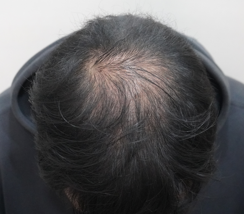 뉴헤어부산 탈모 주사치료 2개월차 후기입니다
