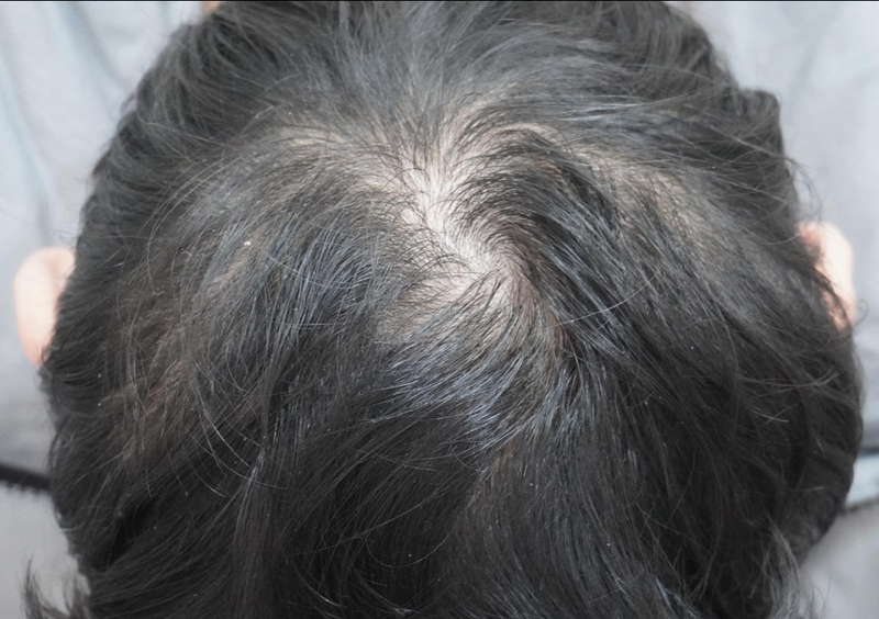 뉴헤어부산에서 8회째 치료 후기 입니다