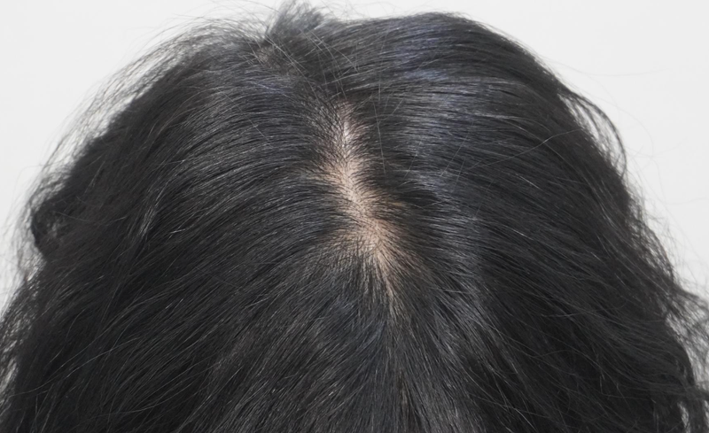 뉴헤어부산의원 탈모 주사 치료 8회차 후기