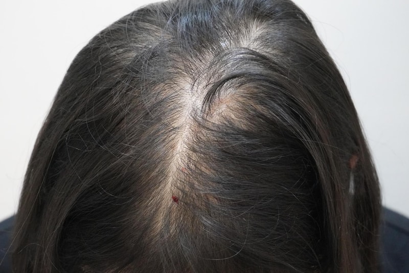 [부산점]뉴헤어모발성형외과에서 주사치료