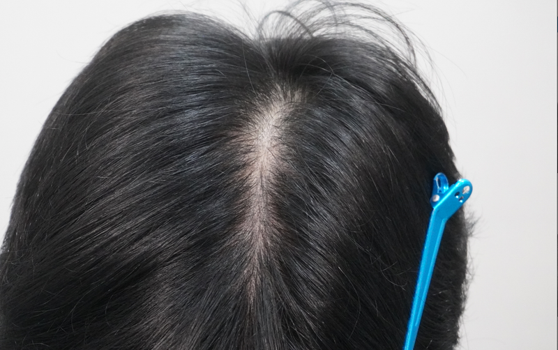 뉴헤어부산점 탈모 치료 8회 차 후기