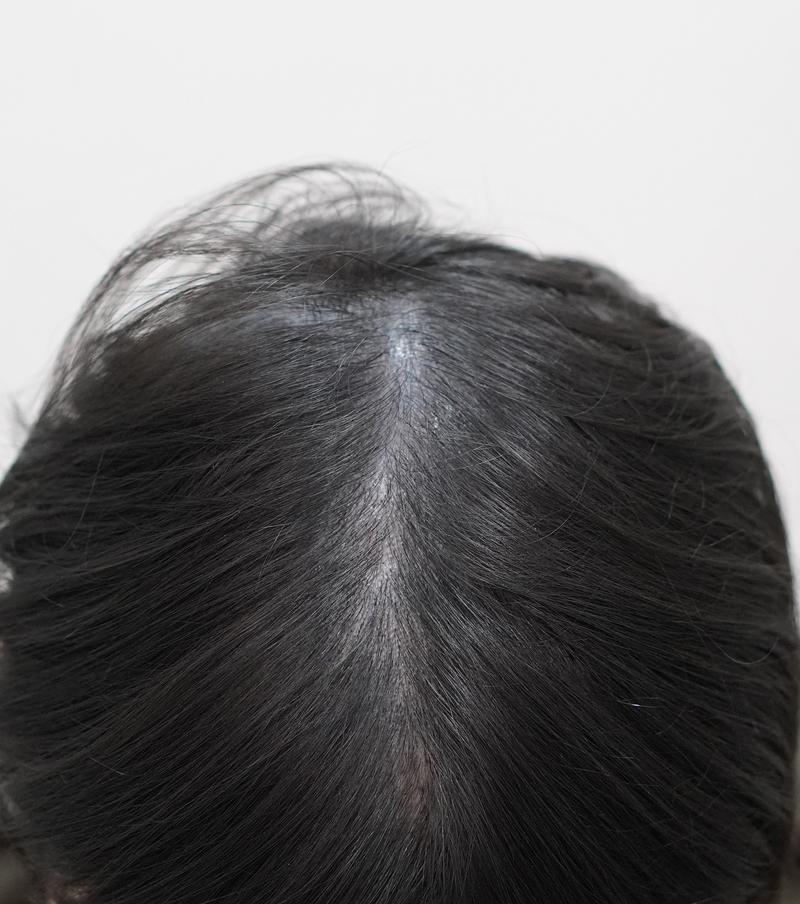 부산 뉴헤어에서 8회차 주사치료 받았어요