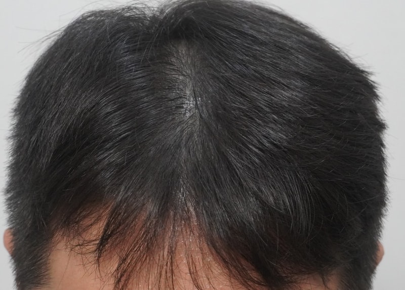 뉴헤어 부산의원 주사치료 방문후기