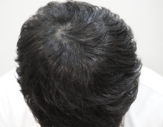 [뉴헤어부산의원]탈모치료 8회차 후기