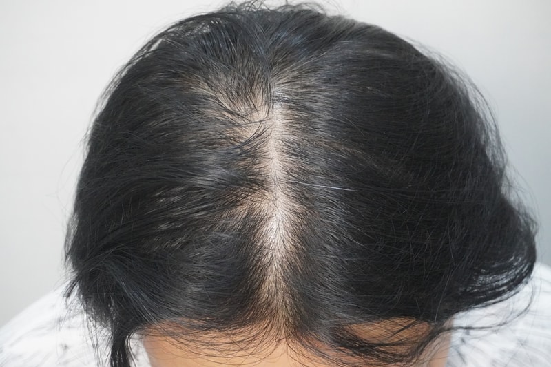 [부산점]뉴헤어모발성형외과에서 주사치료 1회차