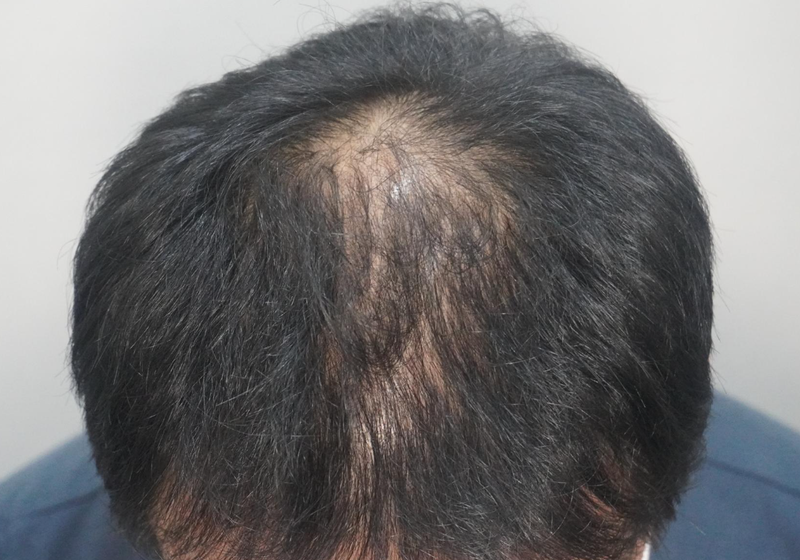 뉴헤어부산점에서 주사 치료 받고 있습니다(8회차)