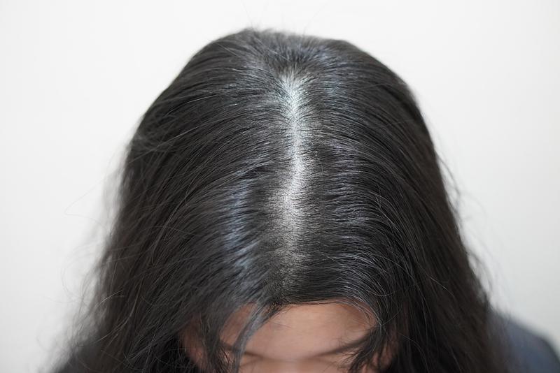 뉴헤어부산점 탈모 주사 치료 6회 차 후기