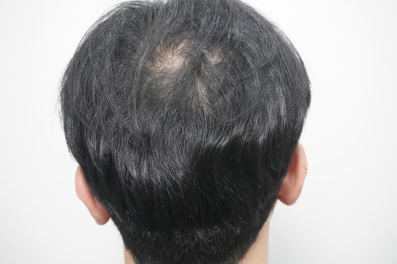 New Hair Busan Clinic 1st Review of Men's Hair Loss Treatment