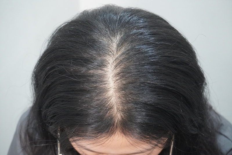 뉴헤어부산의원에서 탈모치료 4회차 입니다