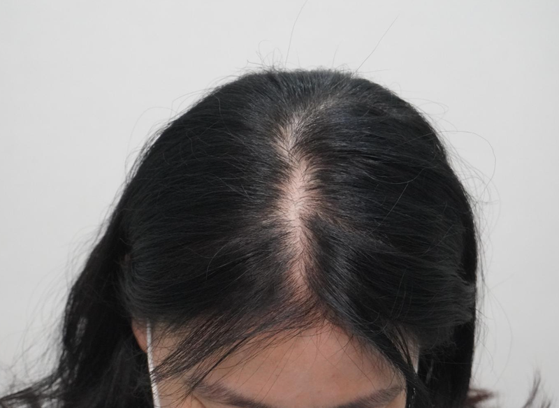 뉴헤어부산의원에서 정수리 헤어라인 탈모 치료 8회차에요