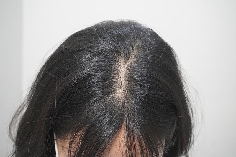 뉴헤어부산의원에서 탈모 치료 1회 차 후기