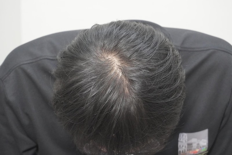 뉴헤어부산점에서 탈모 치료 후기
