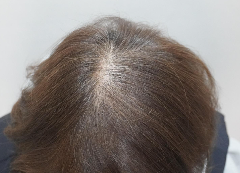 뉴헤어부산의원 탈모 주사 치료 12회차 후기