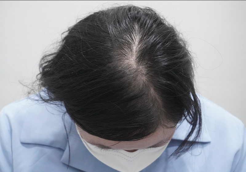 [부산점]뉴헤어모발성형외과에서 탈모 치료 시작 !