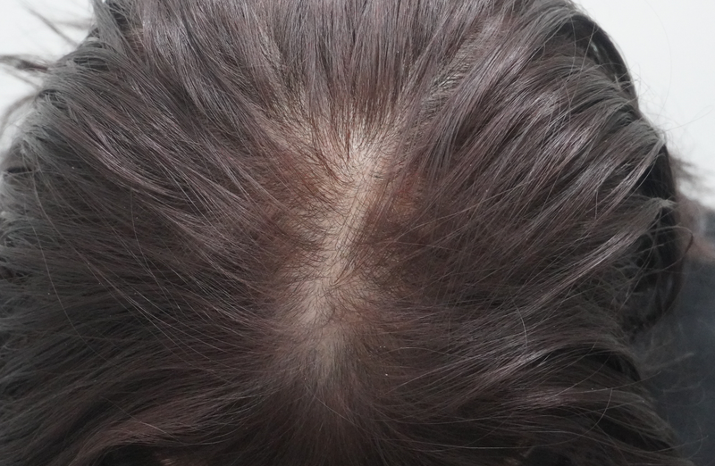 뉴헤어부산의원 4번째 탈모치료 후기