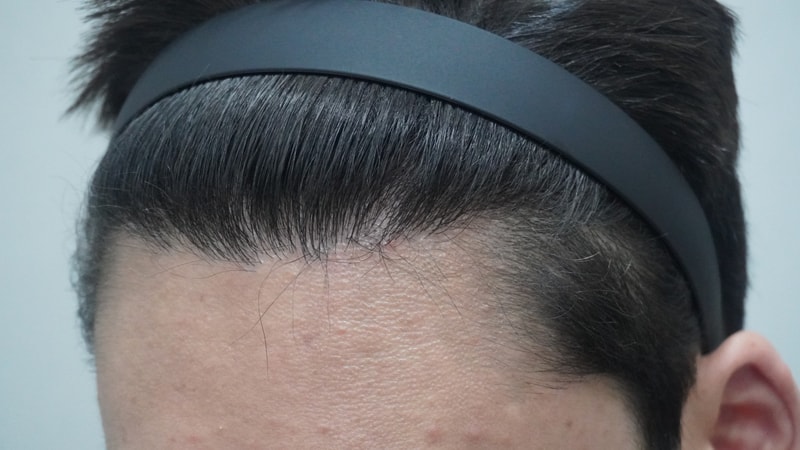 모발이식 후 부산 뉴헤어의원에서 치료 시작 했습니다