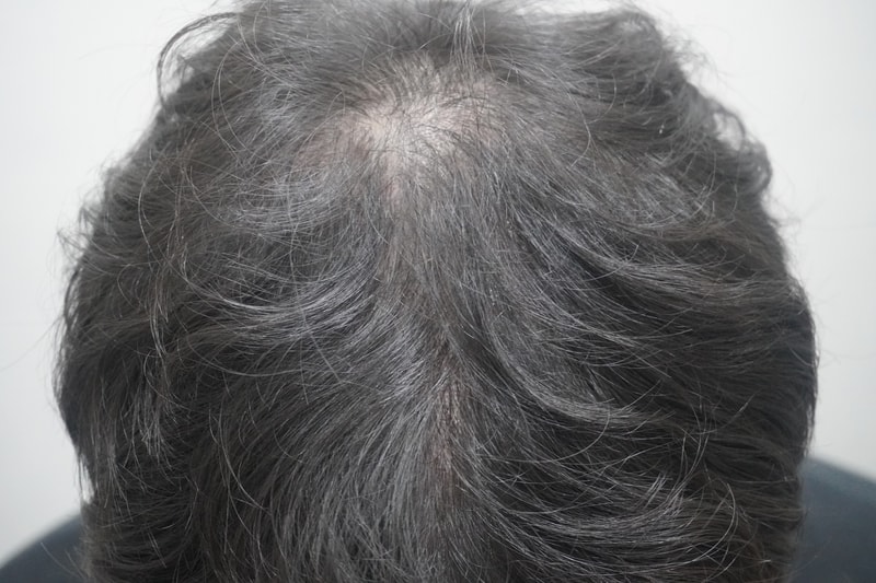 뉴헤어부산 탈모 치료 상담, 탈모 치료 1회 차 후기
