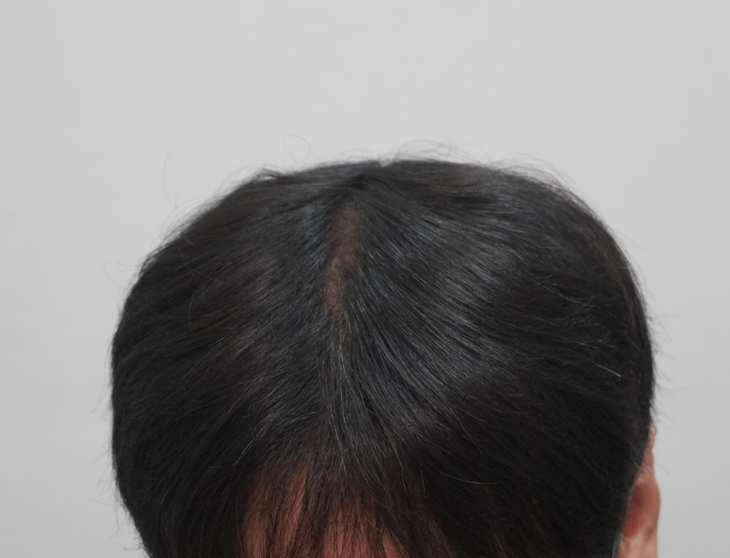 뉴헤어부산의원 탈모 치료 4회 차 후기~