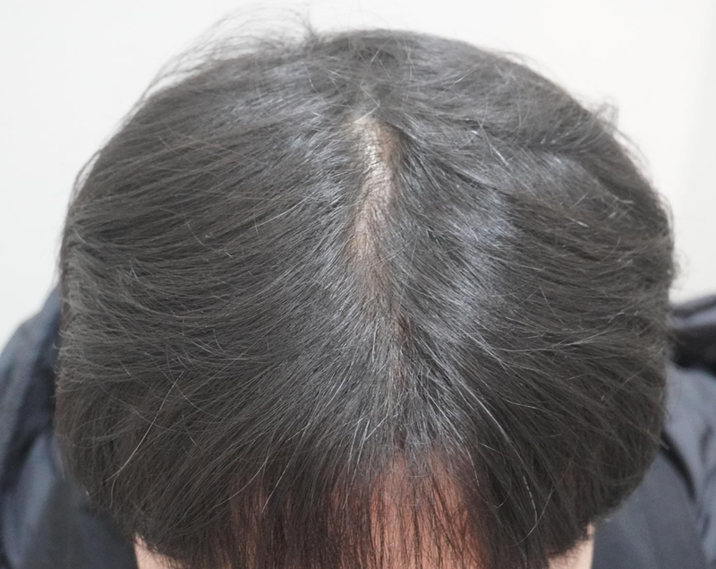 뉴헤어부산의원 탈모 주사 치료 8회차입니다