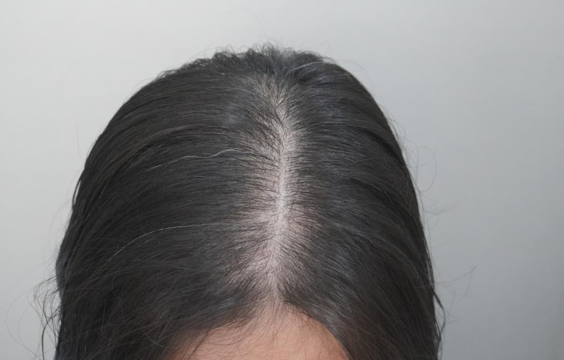 뉴헤어 부산점 탈모 치료 4회차 후기입니다.