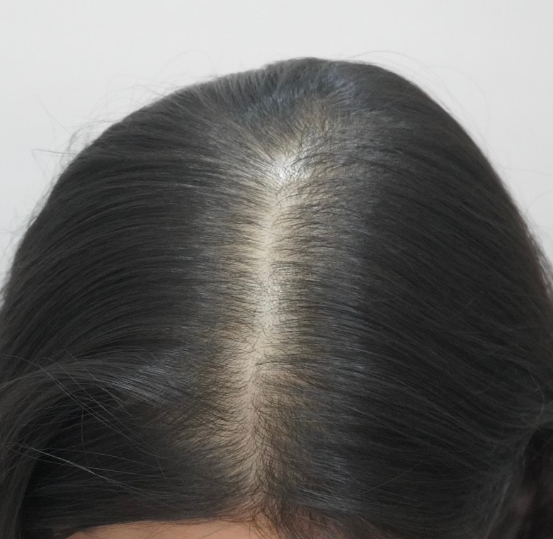 뉴헤어부산에서 탈모 치료 8회 차 후기입니다