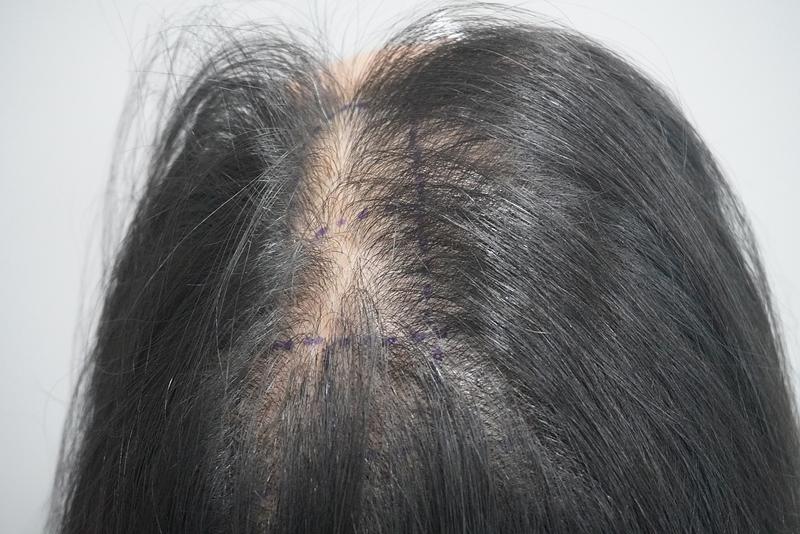 뉴헤어 [부산점] 모발이식수술 2500모 후기