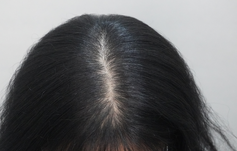 뉴헤어부산의원 탈모 주사 치료 8회차 후기