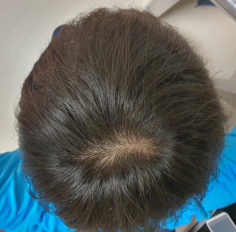 [부산] 뉴헤어의원에서 탈모주사 치료 1회차! 탈모약으로는 아쉬운 분들을 위한 맞춤형 치료