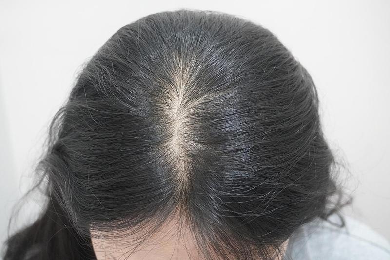 뉴헤어부산의원에서 모낭주사 8회차에요~