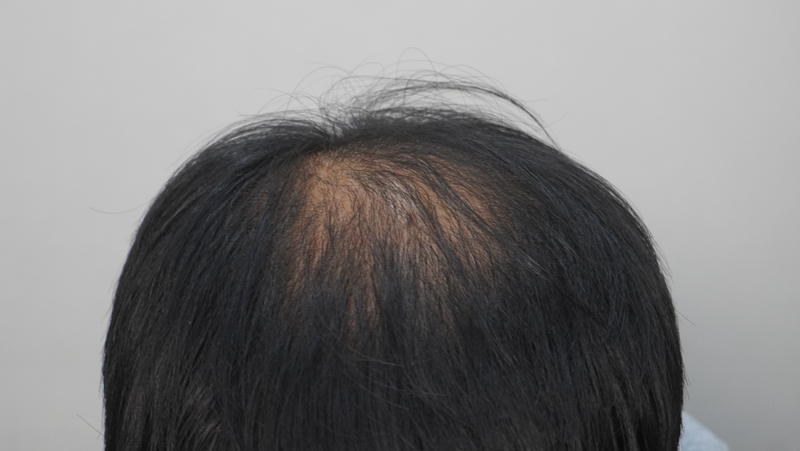 뉴헤어부산의원에서 4500모 이식 전 탈모 치료 시작