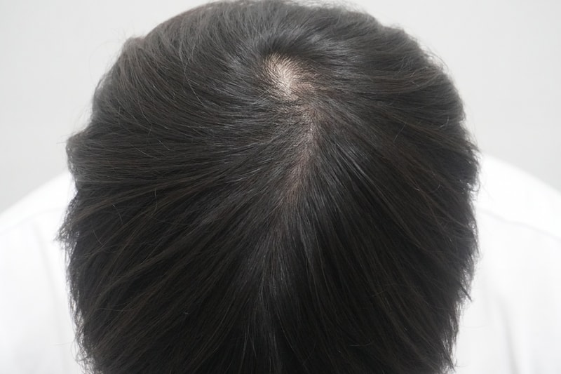 뉴헤어부산의원에서 탈모 치료 4회 차 진행했습니다