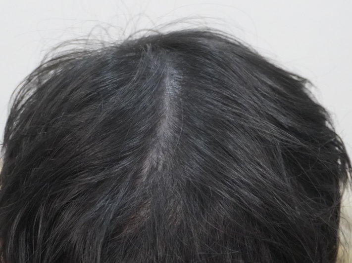 뉴헤어 부산에서 시술 4회